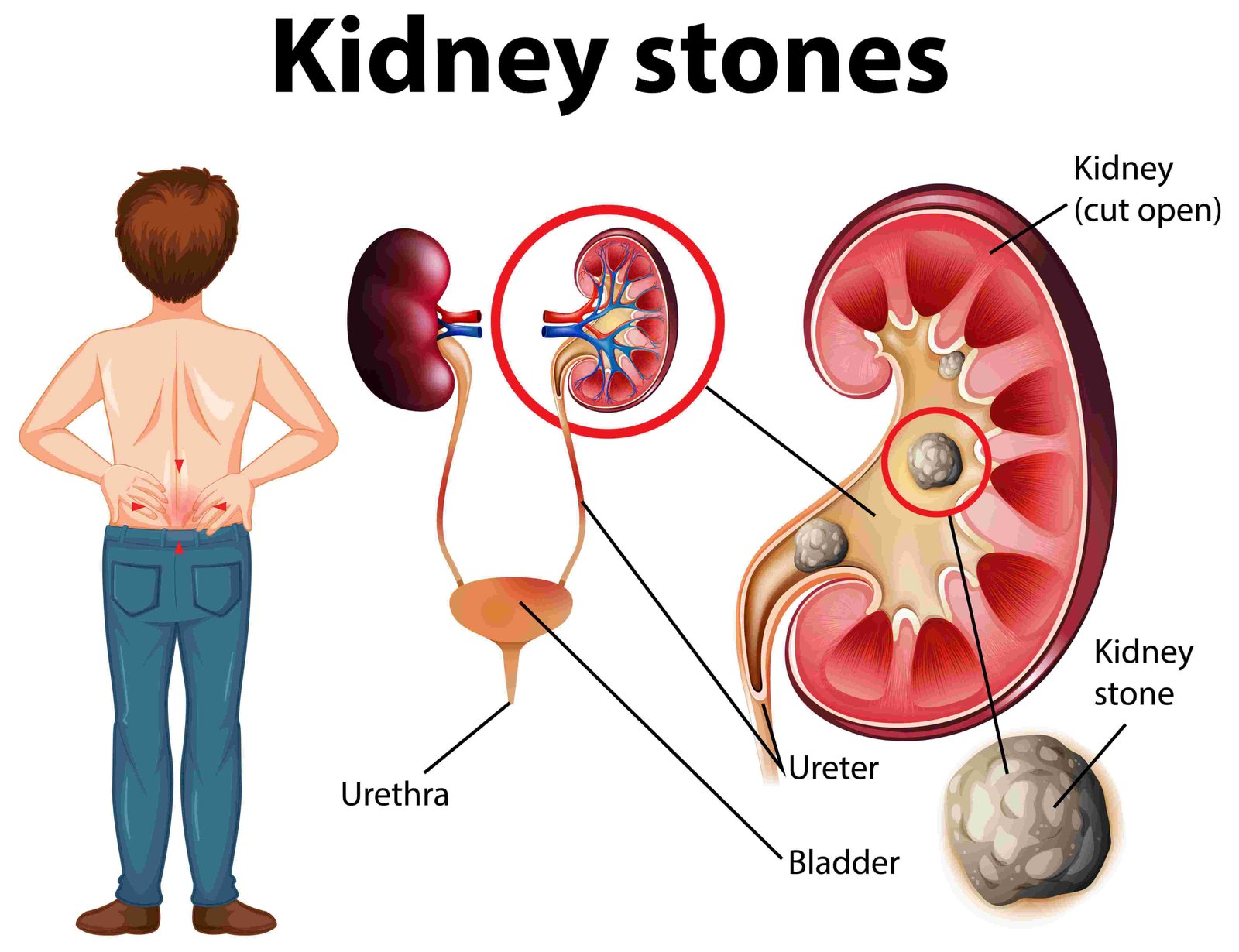 Pass Kidney Stones Quickly At Home