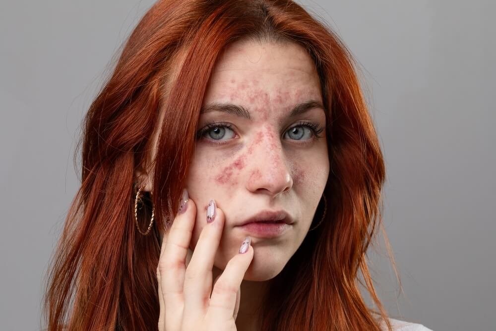 how-to-get-rid-of-eczema-on-face-in-one-day
